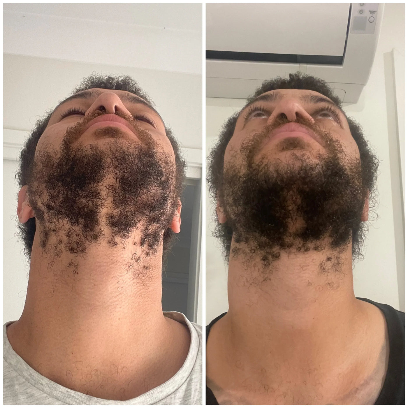 Before and after beard growth results showing thicker facial hair under the chin